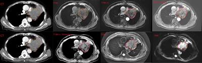 Reduction of inter-observer variability using MRI and CT fusion in delineating of primary tumor for radiotherapy in lung cancer with atelectasis
